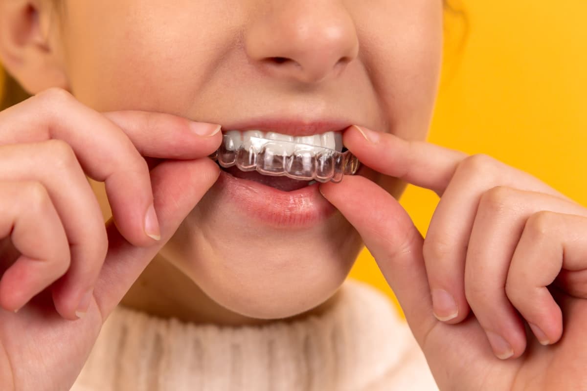 Patient placing a clear orthodontic aligner